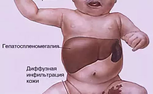сифилис лечение
