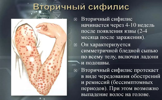 сифилис лечение