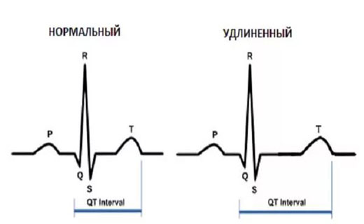 атеросклероз