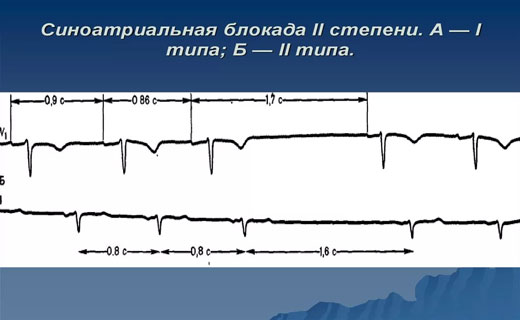 атеросклероз