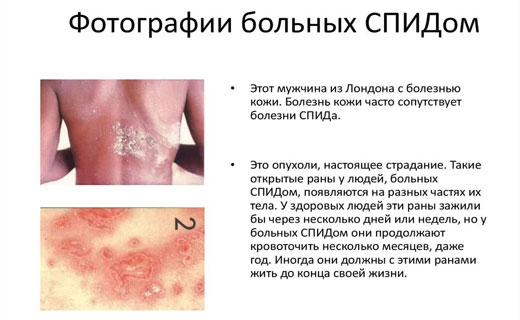 вирус спида