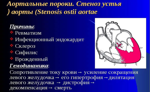 причины стеноза