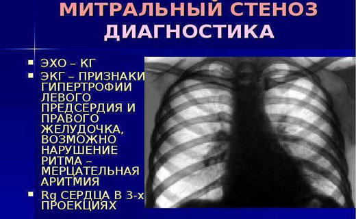 атеросклероз