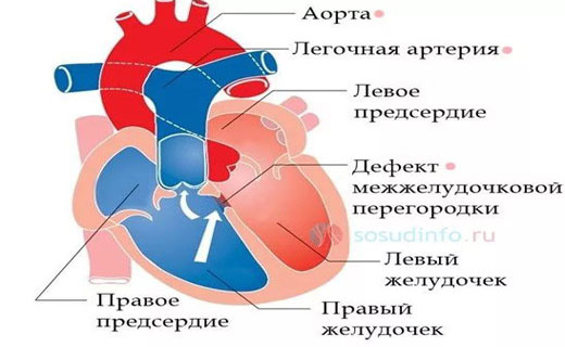 атеросклероз
