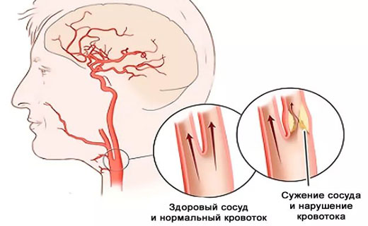 атеросклероз