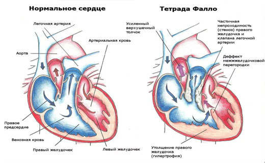 атеросклероз