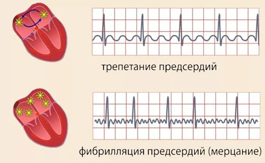 атеросклероз