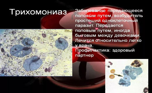 трихоманиаз
