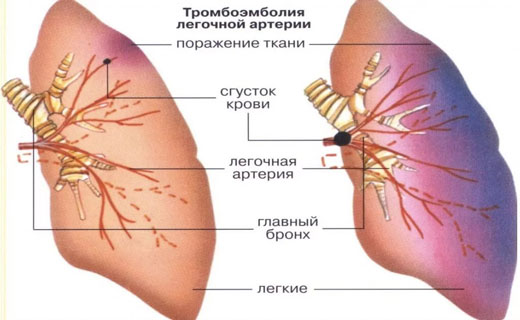 тромбоэмболия