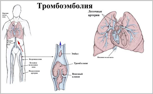 тромбоэмболия
