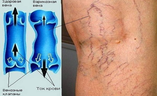 Варикозный дерматит
