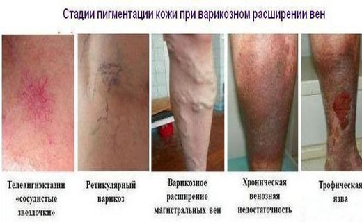 Варикозный дерматит