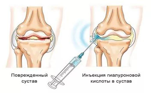 артрит