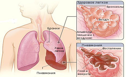 спаление легких