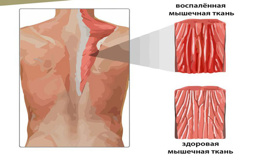 воспаление мышц
