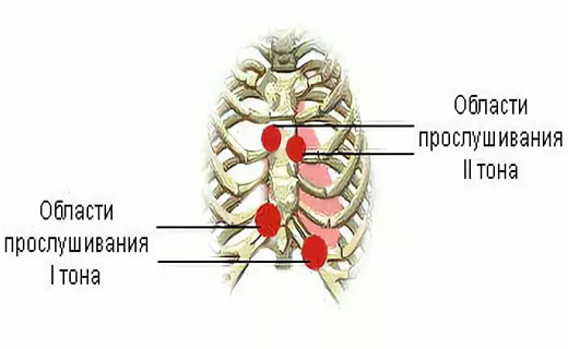 дистония