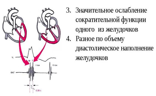 дистония