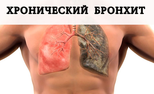 бронхит