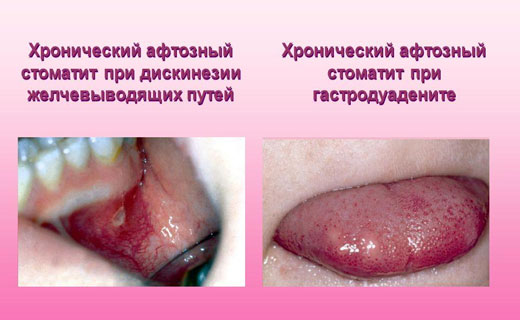 хронисечкий стоматит