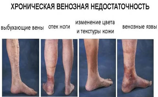 сосудистая недостаточность