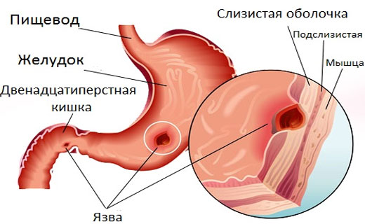 язвенные болезни желудка