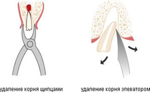 зачем удалять корень зуба