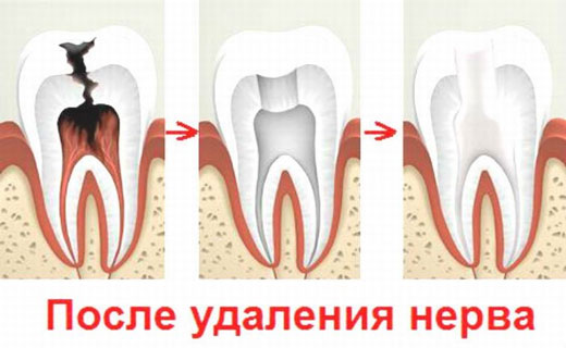 зачем удалять нерв зуба