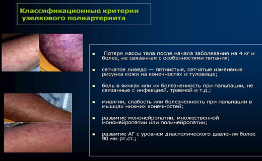 полиартрит