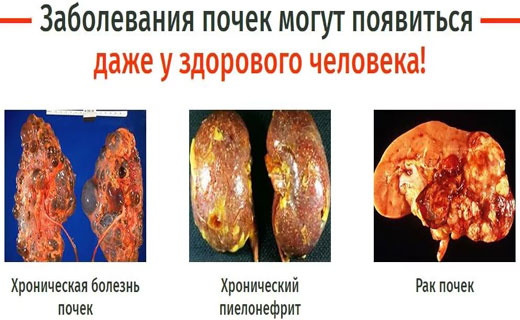 почки
