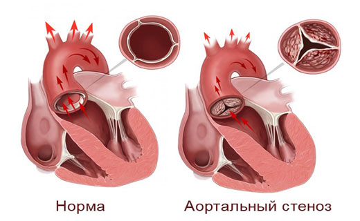 стеноз аорты