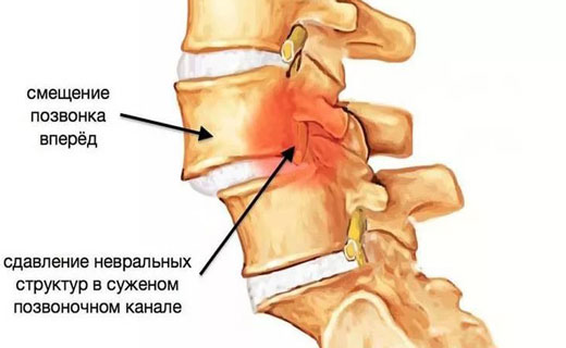 смещение позвонков