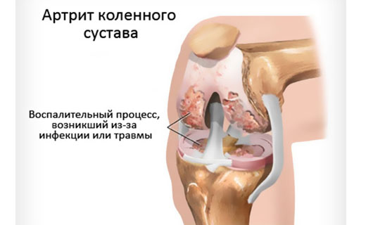 септический артрит