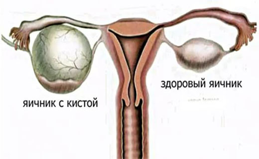 киста яичника