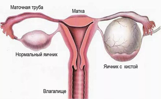 киста