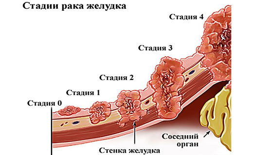 рак желудка