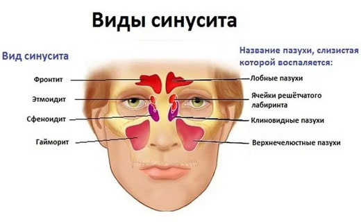 синусит