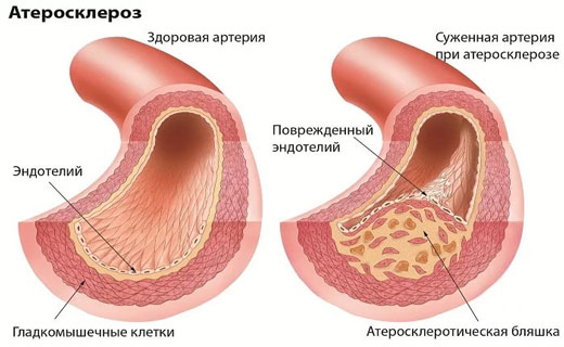 атеросклероз