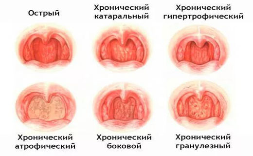 фарингит