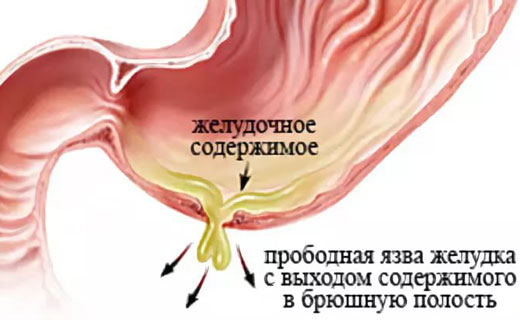 перитонит внутренних органов