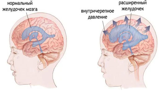 повышенное внутричерепное давление