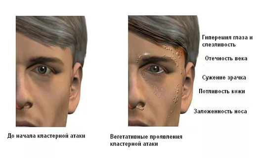 кластерные боли