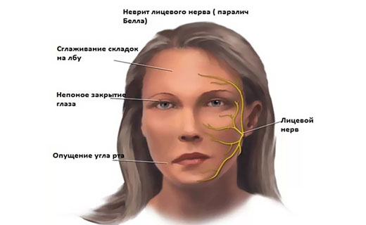 неврит
