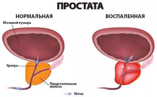 мужской простатит