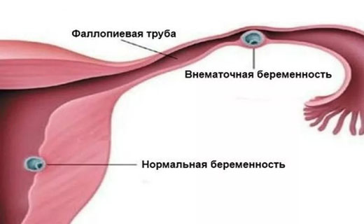 внематочная беременность