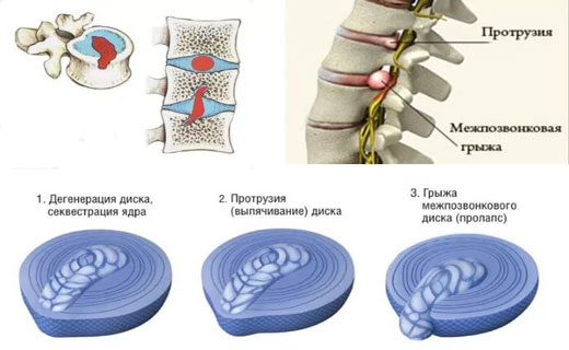 межпозвоночная грыжа