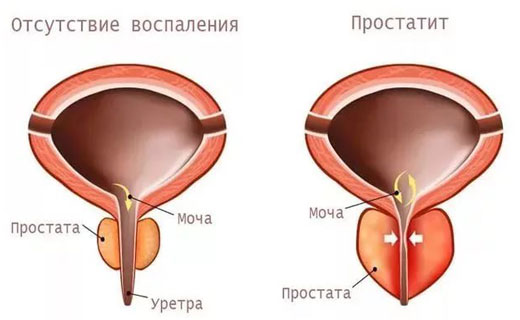 простатит
