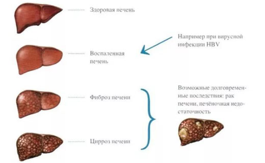 цирроз печени
