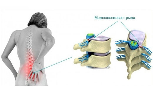 межпозвоночная грыжа