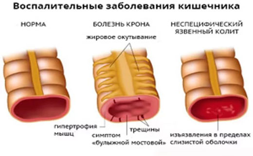 воспаления кишечника