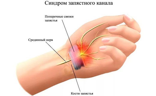 синдром запястного канала